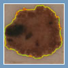 wideodermatoskopia
