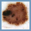 wideodermatoskopia