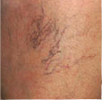 laseroterapia znamiona